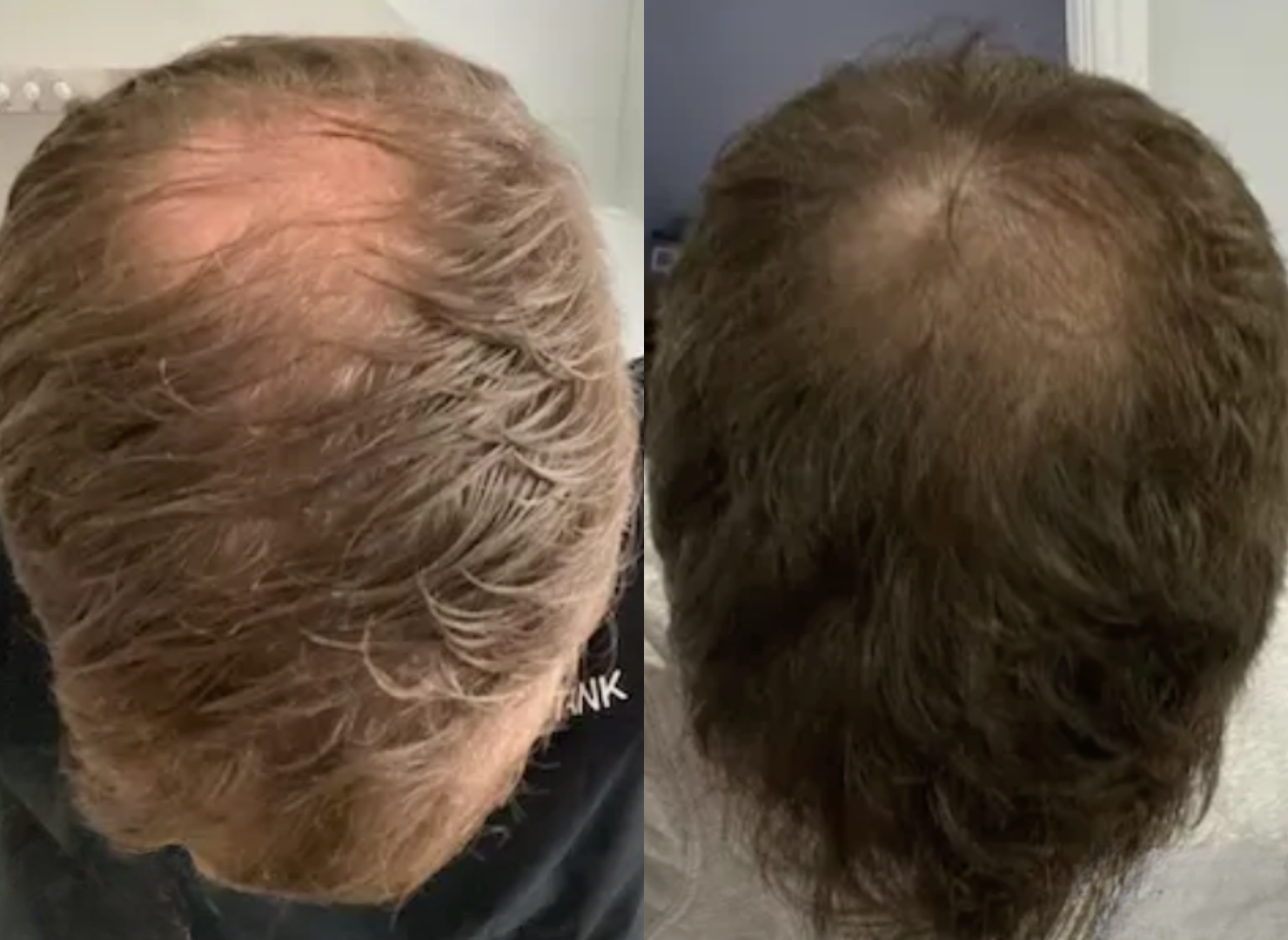 Hair Loss Comparison