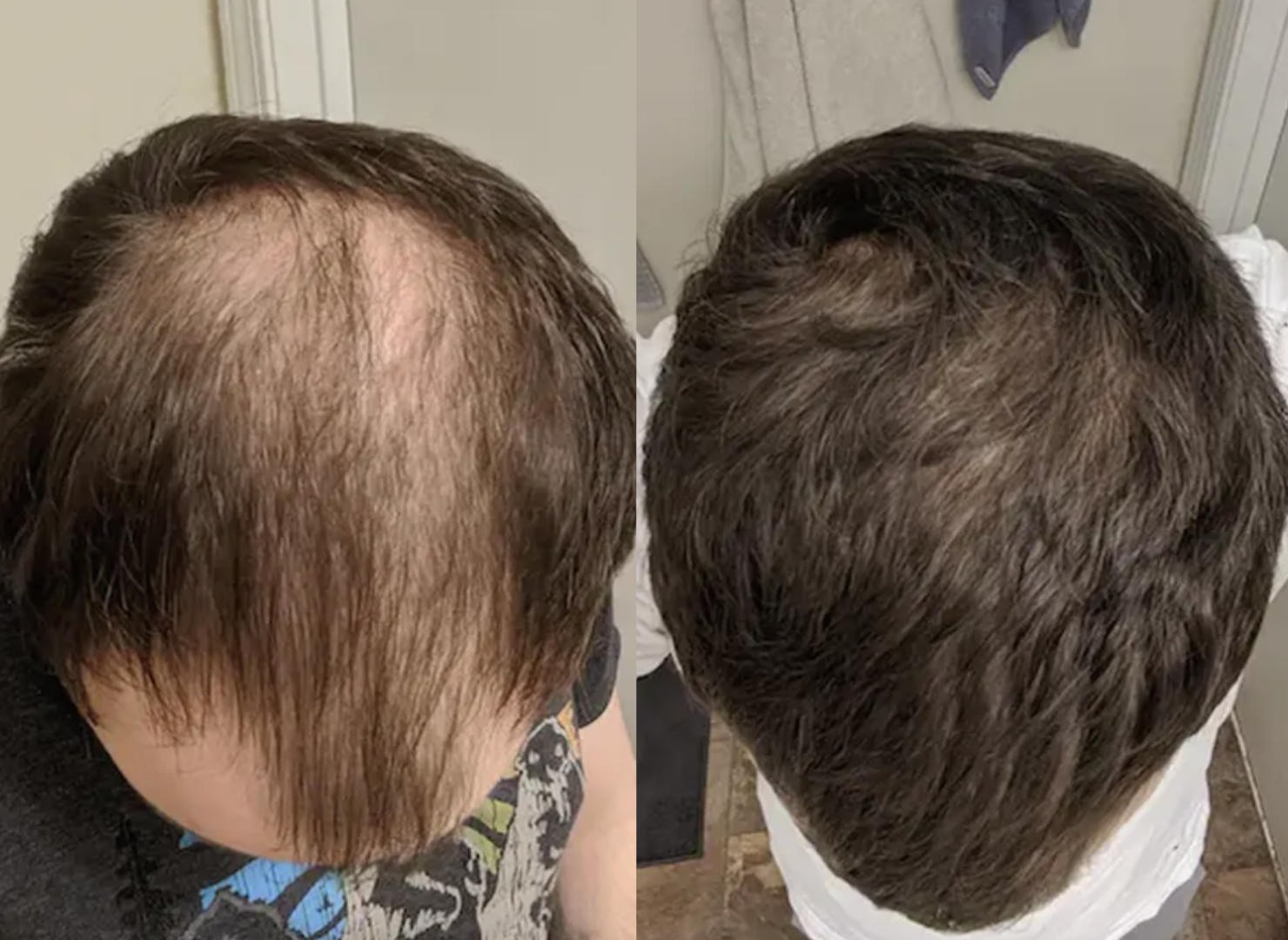 Before and After Hair Loss Comparison