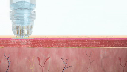 Microneedle Technology